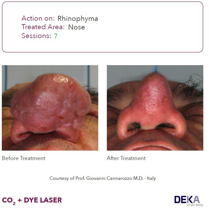 antes y despues laser DYE colorante pulsado Synchro vas Q resultados antes y despues DEKA 