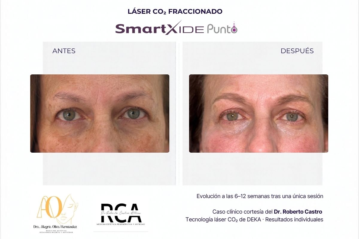 Comparación de los párpados y el contorno de ojos antes y después de una sesión de láser CO₂.