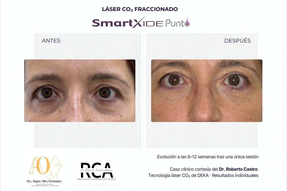 Evolución de la piel alrededor de los ojos tras el tratamiento con láser CO₂ SmartXide Punto de DEKA.