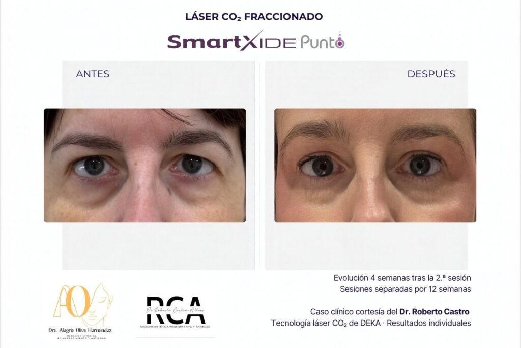 Evolución de la piel alrededor de los ojos tras el tratamiento con láser CO₂ SmartXide Punto de DEKA.