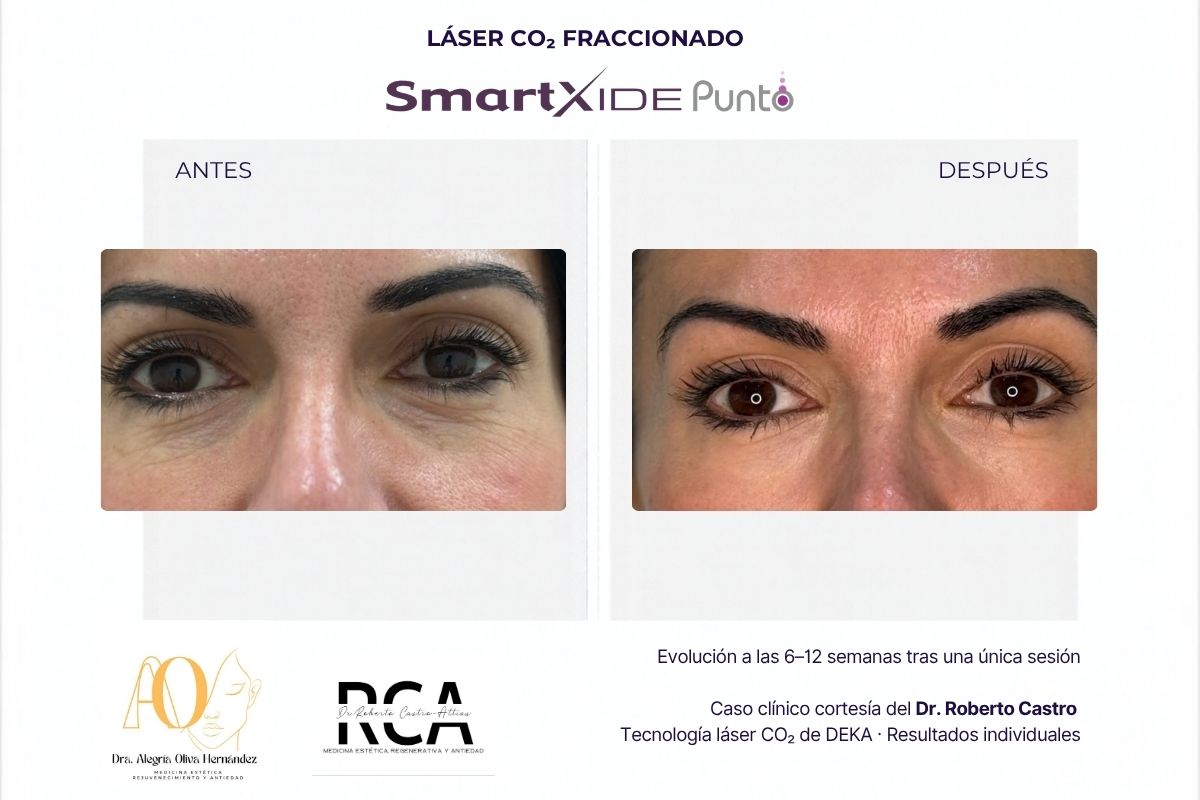 Antes y después de la piel del párpado superior tras un tratamiento con láser CO₂ DEKA SmartXide Punto.