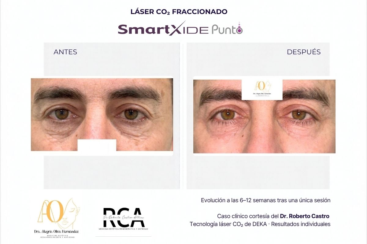 Comparativa del párpado inferior antes y después de un tratamiento con láser CO₂ DEKA SmartXide Punto.