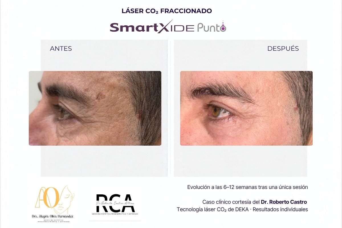 Antes y después de la zona bajo los ojos tras una sesión de láser CO₂; caso del Dr. Roberto Castro.