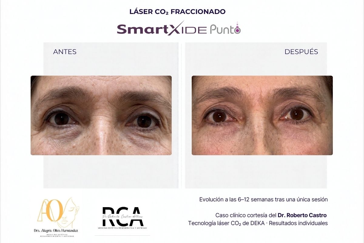 Comparación de la piel de los párpados inferiores antes y después de una sesión con SmartXide Punto.