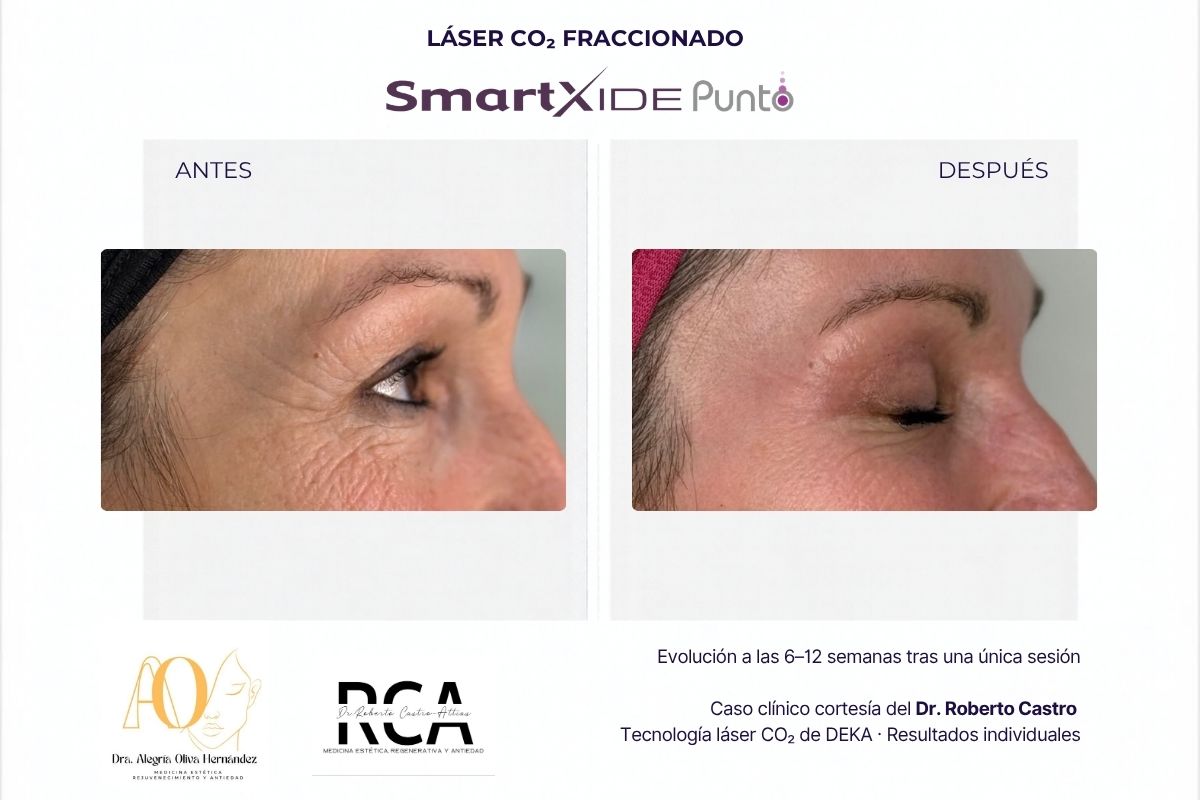 Comparativa del contorno de ojos antes y después de una sesión con láser CO₂ SmartXide Punto.