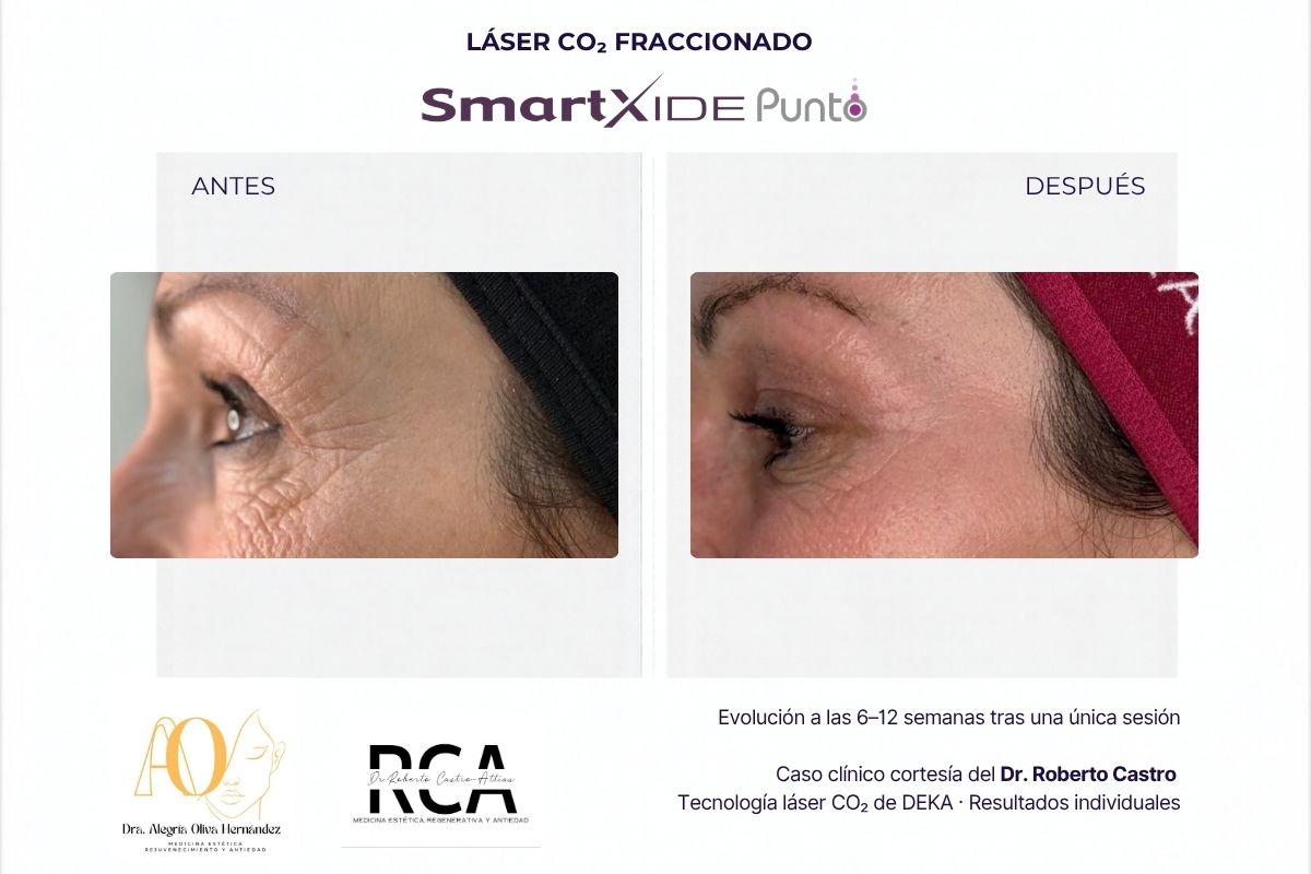 Antes y después de la zona periocular tratada con láser CO₂ DEKA; caso del Dr. Roberto Castro.