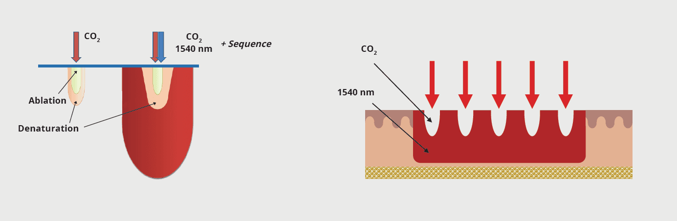 Esquema de la acción del láser DUOGlide de DEKA: combinación de ablación con CO₂ de 10.600 nm y efecto térmico de 1540 nm en el tejido cutáneo.