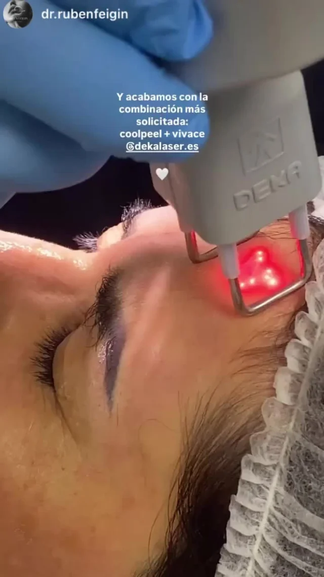 Tratamiento combinado: CoolPeel + Vivace
La sinergia entre el láser CO₂ fraccionado superficial (CoolPeel) y la radiofrecuencia fraccionada con microagujas (Vivace) permite tratar simultáneamente las capas epidérmica y dérmica con mínima inflamación y sin tiempo de inactividad significativo.

🟠 CoolPeel: ablación superficial controlada (sin carbonización), ideal para textura, poros, manchas finas y fotoenvejecimiento leve.
🔵 Vivace: RF bipolar + microneedling, que actúa a nivel dérmico profundo, promoviendo neocolagénesis y remodelación tisular.

✔️ Indicaciones: arrugas finas, laxitud leve-moderada, cicatrices de acné, poros dilatados, discromías leves.
✔️ Mínimo downtime, excelente tolerancia, resultados progresivos y naturales.
✔️ Protocolos personalizables según fototipo, tipo de piel y nivel de daño.

Una estrategia eficaz para el rejuvenecimiento integral con mínima agresividad.

#CoolPeel #VivaceRF #TratamientoCombinado #RejuvenecimientoAvanzado #LáserCO2Fraccionado #RadiofrecuenciaFraccionada #ColágenoNeogénesis #TecnologíaMédica #MedicinaRegenerativa #ProtocolosFaciales