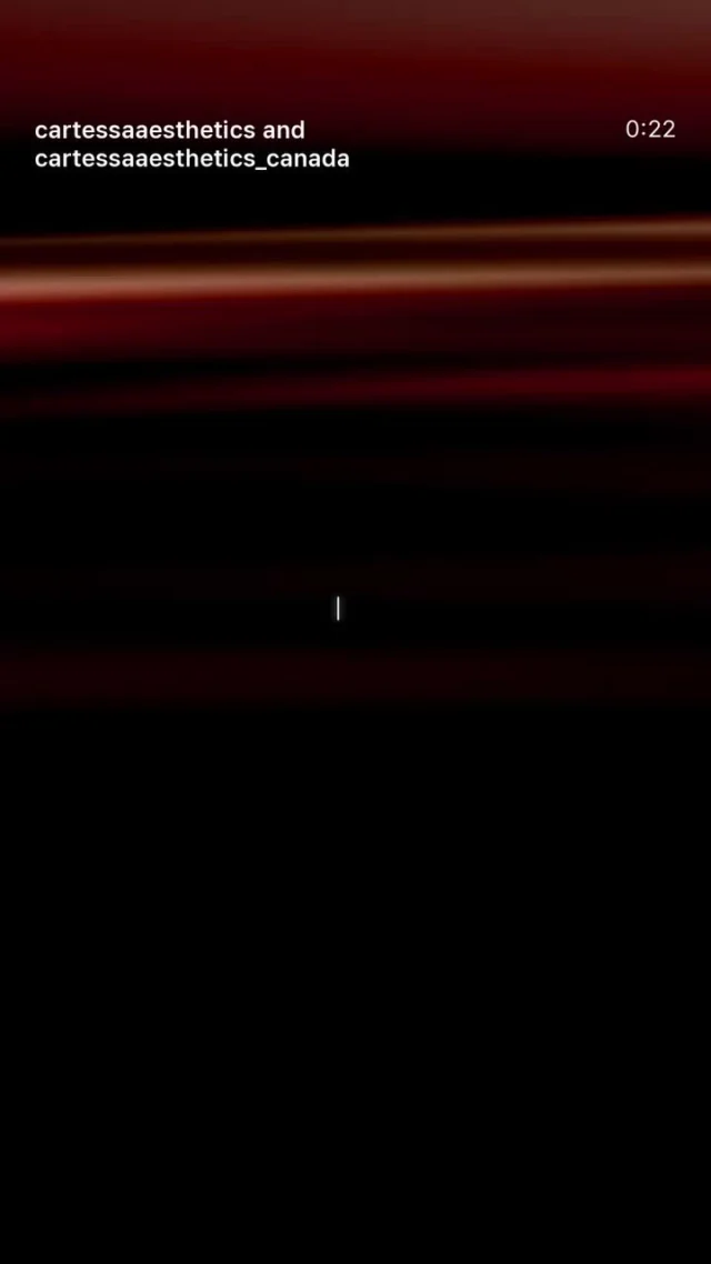 TORO de DEKA combina emisión en picosegundos y nanosegundos con tres longitudes de onda (785, 532 y 1064 nm), ofreciendo máxima versatilidad clínica:

✔️ Lesiones pigmentadas benignas (superficiales y profundas)
✔️ Eliminación de tatuajes (traumáticos, alérgicos, multicolores)
✔️ Tonificación cutánea, melasma y rejuvenecimiento (con DEKAPeel)
✔️ Tratamiento de cicatrices, incluyendo acné severo

Con múltiples piezas de mano (round, square, fraccional y peeling) y emisión Nd:YAG Q-Switched, TORO permite personalizar parámetros con precisión milimétrica, optimizando la eficacia y la seguridad incluso en fototipos III a V.

TORO. Evolución de la excelencia en láser dermatológico.

#TOROdeDEKA #DEKALaser #DEKA #LáserMédico #LáserDermatológico #TecnologíaDEKA #LáserAvanzado #NdYAG #Picosegundos #Nanosegundos #QSwitched #EliminacióndeTatuajes #LesionesPigmentadas #RejuvenecimientoFacial #MelasmaTratamiento #CicatricesdeAcné #TratamientoFacial #Láserparacicatrices #Dermatologíaláser #MedicinaLáser #Dermatólogia #LáserDeAltaPrecisión #EquipamientoMédico #InnovaciónMédica