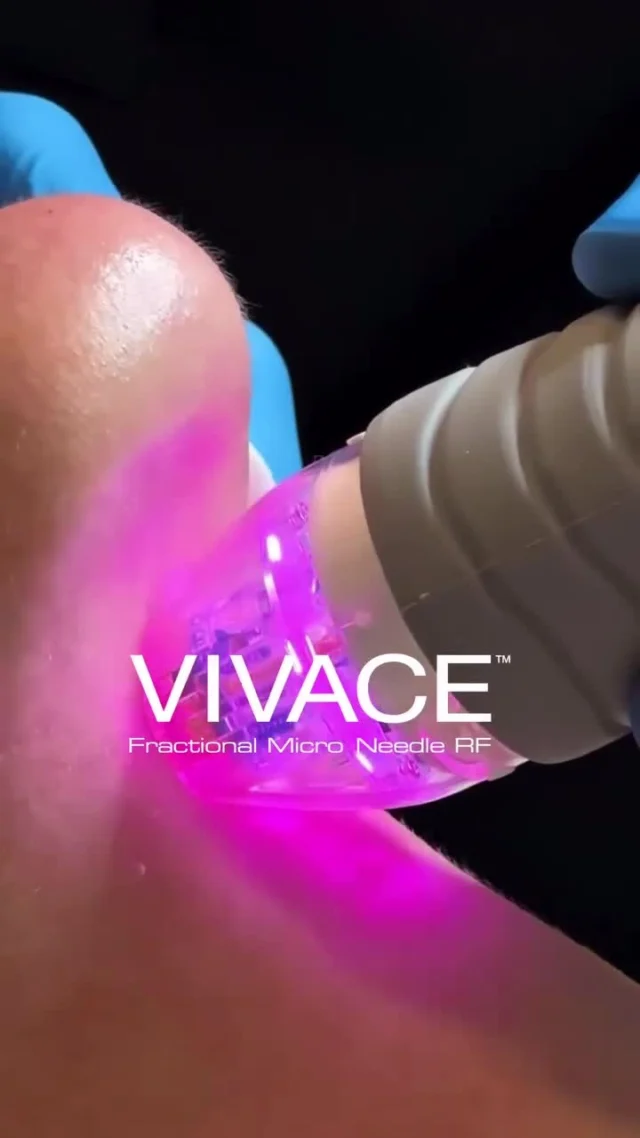 Resultados que se notan. Confianza que se siente.
Vivace une la potencia de la radiofrecuencia fraccionada con la precisión del microneedling para activar la producción natural de colágeno y elastina.

✔️ Ideal para tratar arrugas finas, flacidez, poros dilatados y cicatrices de acné
✔️ Tecnología mínimamente invasiva, sin tiempo de baja
✔️ Alta eficacia clínica y gran aceptación entre los pacientes
✔️ Mejora progresiva con resultados naturales

Una solución segura, respaldada por evidencia científica y resultados consistentes.

#shenb #vivacerf #rejuvenecimientofacial #esteticamedica #tecnologiaestetica #colageno #dekalaser #microneedling #radiofrecuencia #dermatologiaestetica #aparatologiaavanzada #microagujas #rejuvenecimientocutaneo #medicinaestetica #tratamientosfaciales