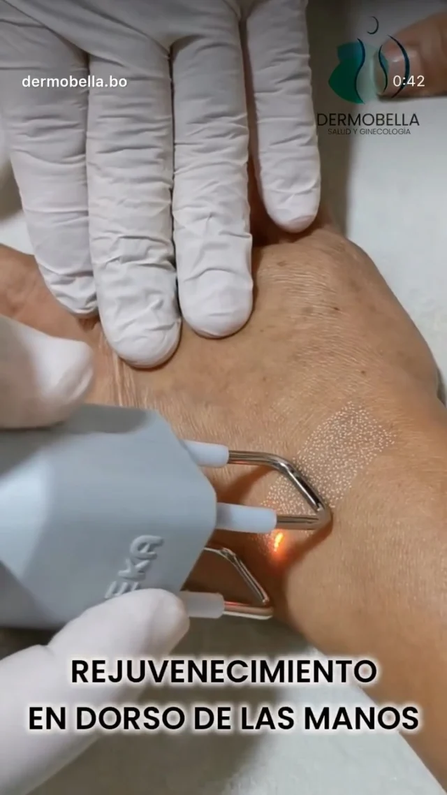 ✨ Rejuvenecimiento de manos con láser CO2 DEKA ✨
La piel de las manos es una de las zonas que más refleja el paso del tiempo. Gracias al láser CO2 de DEKA, podemos corregir manchas, mejorar textura y activar la regeneración natural para unas manos visiblemente más jóvenes y saludables.
Precisión y eficacia médica. Resultados seguros y duraderos.
Confía en DEKA para ofrecer a tus pacientes lo mejor en tratamientos regenerativos.

#DEKALaser #deka #laserco2 #DuoGlide #Punto #Tetra #CoolPeel #smartxide #Dermatología #cicatrices #marcasdeacne #eliminacióndemanchas #manchasenlasmanos #co2 #arrugas #lesionespigmentadas