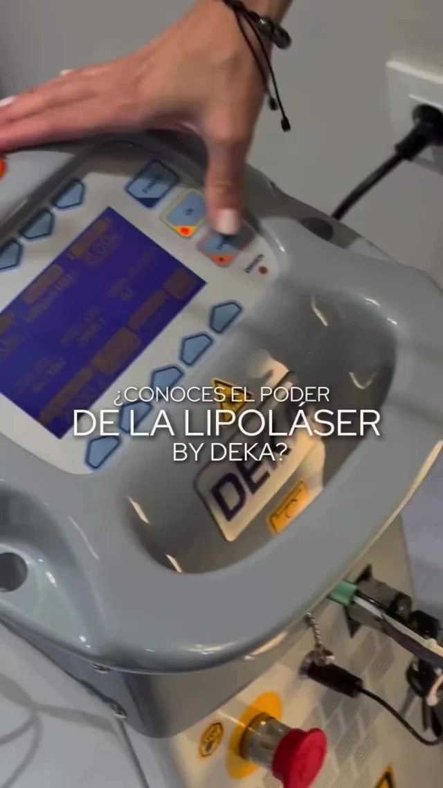 ¿Conoces el poder de Smartlipo?
💥 Por #DEKAlaser, la tecnología médica que transforma los resultados.

Hoy te presentamos Smartlipo de DEKA, un sistema de alta precisión ideal para zonas como la papada, presentado por el Dr. Diego Sturletti (@drdiegosturletti), referente en tratamientos con láser.

🔍 ¿Por qué elegir Smartlipo?
Estos son sus 3 beneficios clave:

1️⃣ Reducción de grasa localizada
Actúa directamente sobre los adipocitos, disolviendo la grasa sin dañar los tejidos cercanos.

2️⃣ Efecto tensor inmediato
El calor del láser estimula la producción de colágeno, dejando la piel más firme y tonificada.

3️⃣ Recuperación exprés
Es un tratamiento mínimamente invasivo, que permite volver a la rutina en poco tiempo.

💡 Ideal para redefinir el contorno facial sin necesidad de cirugía.

#Smartlipo #LáserMédico #TecnologíaDEKA #Papada #GrasaLocalizada #ContornoFacial #RejuvenecimientoFacial #SinCirugía #DEKAlaser #MedicinaAvanzada #DrCarlosDiegoSturletti #dekalaser #laserlipolisis #tratamientofacial #saludybelleza #lipoláser