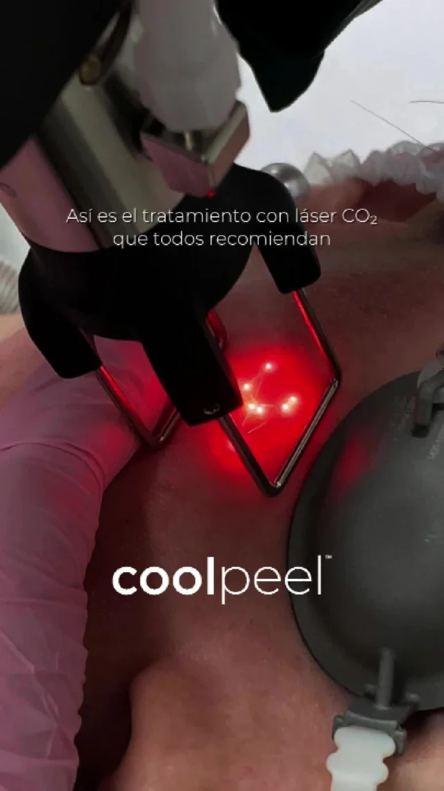 🌞 Rejuvenecer la piel en verano, sí es posible.
Con el protocolo de láser CO₂ fraccionado en baja densidad, COOLPEEL, puedes mejorar textura, tono y firmeza de la piel sin comprometer la seguridad del paciente.

🔬 Estimulación suave del colágeno
💡 Mejora progresiva de la luminosidad
😌 Mínimo tiempo de recuperación

Ideal para pieles fotoenvejecidas, apagadas o con poros dilatados, incluso en meses de sol (con la fotoprotección adecuada).

¿Lo estás ofreciendo ya en tu consulta?

#RejuvenecimientoFacial #LaserCO2 #BajaDensidad #DEKALaser #DermatologíaAvanzada #TecnologíaMédica #PielSaludable #MedicinaRegenerativa #TratamientosDeVerano #SinDowntime #DEKAEspaña #coolpeel #deka
