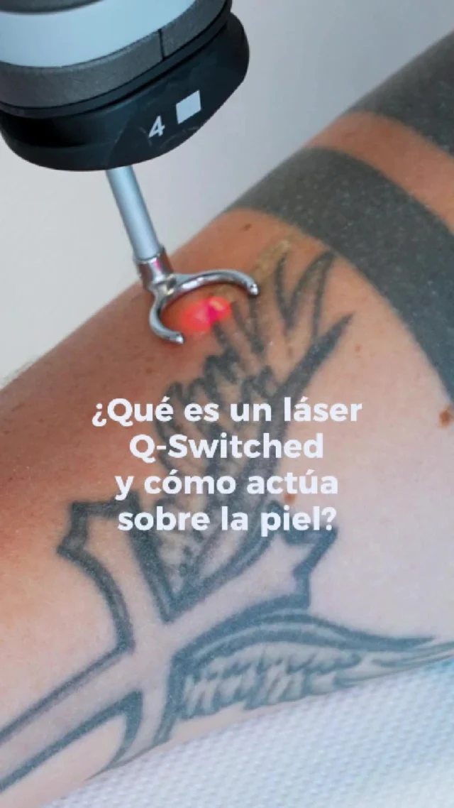 💥 ¿Qué es un láser Q-Switched y cómo actúa sobre la piel?

Se trata de una tecnología de alta precisión que emite pulsos ultracortos (en nanosegundos) para fragmentar pigmentos sin dañar la piel.
Actúa con efecto fotoacústico, rompiendo tinta de tatuajes o exceso de melanina en partículas que el cuerpo elimina de forma natural.

🟡 Alta precisión sobre la pigmentación
🟢 Mínimo daño térmico
🔵 Resultados visibles desde las primeras sesiones

Ideal para:
✔️ Borrado de tatuajes
✔️ Manchas pigmentarias
✔️ Melasma y lentigos

Una solución segura, eficaz y no invasiva con respaldo científico.

#LaserQSwitched #TecnologíaLáser #EliminaciónDeTatuajes #TratamientoDeManchas #Melasma #DEKALaser #MedicinaAvanzada #DermatologíaLáser #PielSaludable #Fotoacústico #DEKAEspaña #toro #torobydeka