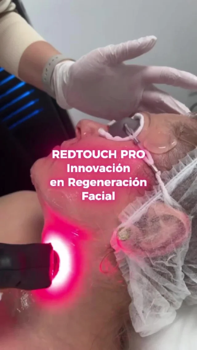 🔴 REDTOUCH PRO: innovación en regeneración facial

Descubre la tecnología exclusiva de RedTouch Pro con su longitud de onda de 675 nm, que actúa directamente sobre colágeno, pigmentación y vascularización para transformar la piel.

✔️ Reduce arrugas y melasma
✔️ Mejora el enrojecimiento y la textura
✔️ Tratamiento no invasivo, sin tiempo de recuperación

💡 Resultados visibles, sin dolor ni interrupciones en la rutina diaria.

Esta avanzada tecnología láser ofrece tres beneficios clave:
✨ Estimulación de colágeno para mejorar firmeza y elasticidad
✨ Textura suave que reduce irregularidades y mejora la uniformidad
✨ Reducción de flacidez para definir el contorno facial

Ideal para quienes buscan una piel de mejor calidad sin tratamientos invasivos.

#RedTouchPro #DEKA #DEKALaser #RejuvenecimientoCutáneo #Colágeno #Fotorejuvenecimiento #Arrugas #Melasma #NoInvasivo #SinDolor #Flacidez #Dermatología #RejuvenecimientoFacial #MedicinaEstética #aparatologiaestetica #aparatologiamedica