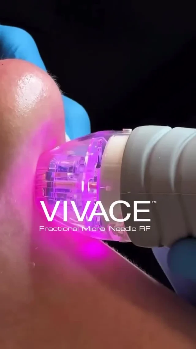 ⚡️ Vivace: radiofrecuencia con microagujas avanzada para una piel más firme y luminosa

Descubre VIVACE, el tratamiento estrella en rejuvenecimiento facial. Con microagujas y radiofrecuencia, logra una piel más firme, luminosa y rejuvenecida. Ventajas: ✅ Estimula colágeno y elastina. ✅ Mejora la textura y firmeza de la piel. ✅ Efectivo en flacidez y marcas de acné. ✅ Sin tiempo de recuperación.
Escríbenos para más información.

¿Querés integrar Vivace en tu clínica? Descubre todo lo que ofrece esta tecnología de última generación.

#Vivace #Radiofrecuencia #Microneedling  #WorkshopDEKA #Rejuvenecimiento #TecnologíaMédica #DEKALaser #MedicinaEstética #PielFirme #TratamientosAvanzados #estrias #RejuvenecimientoFacial #acne #marcasdecane #tratamientofacial